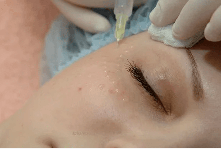 Mesoterapia