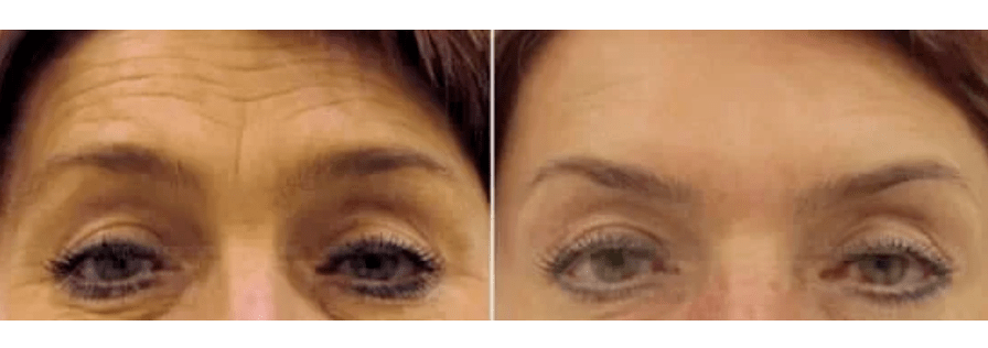 Zatikako gaztetzeko gailuak