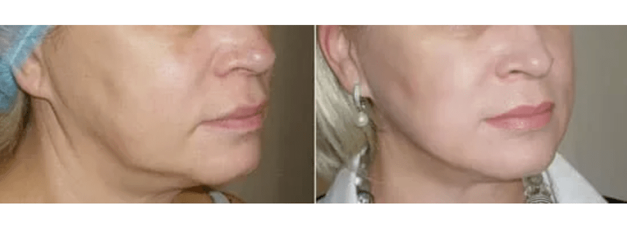 larruazala gaztetu ondoren berreskuratzea