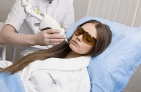 laserren gaztetze zatikatua