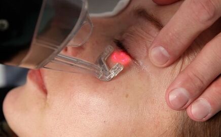 laser aurpegiko azala gaztetzeko prozedura